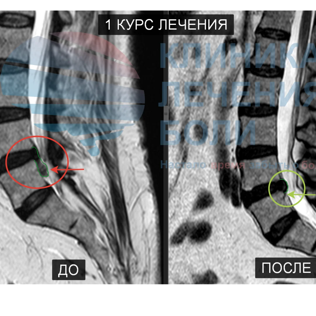 Кейс из практики. Грыжа на уровне L4-L5