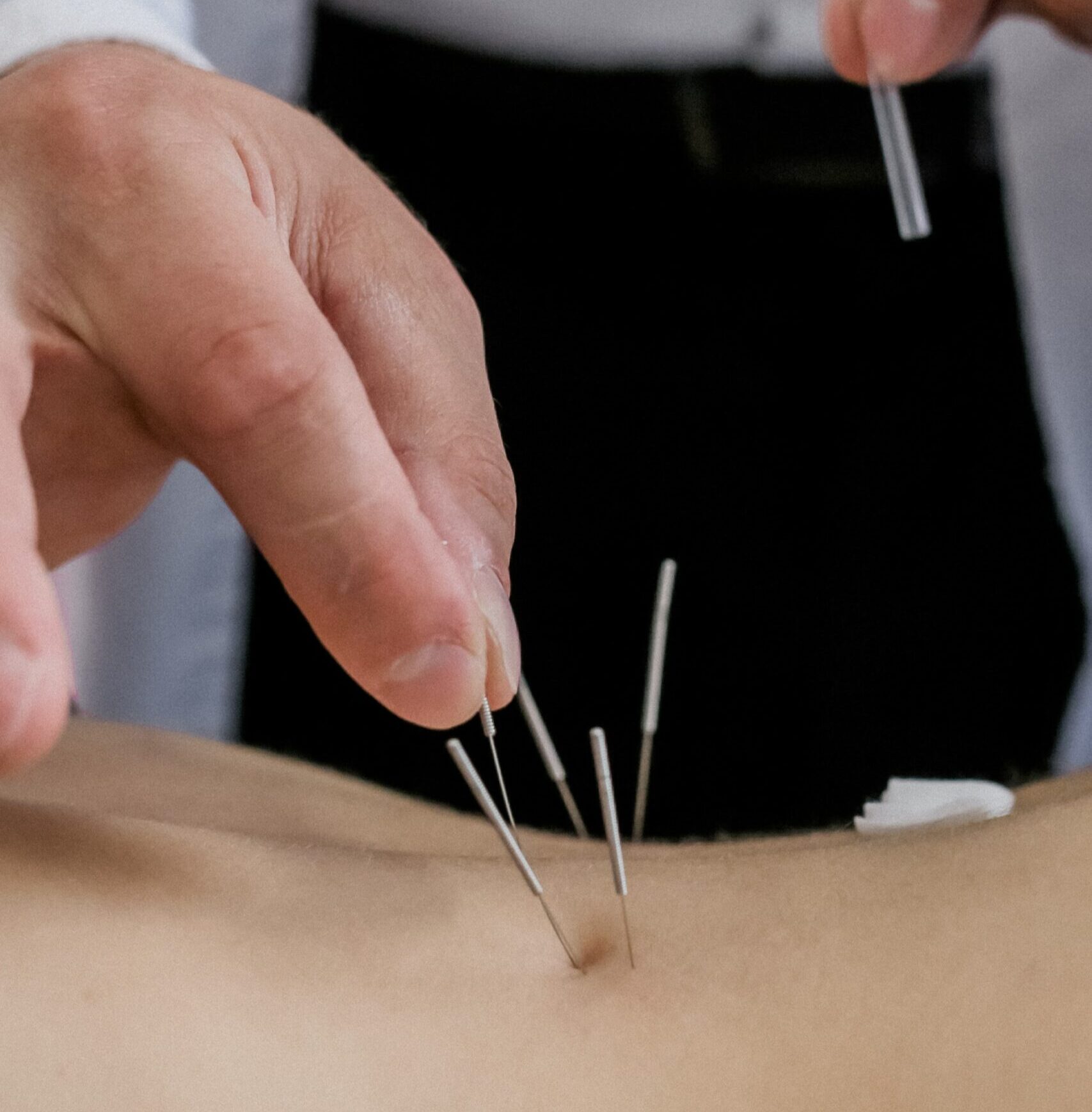 Иглорефлексотерапия