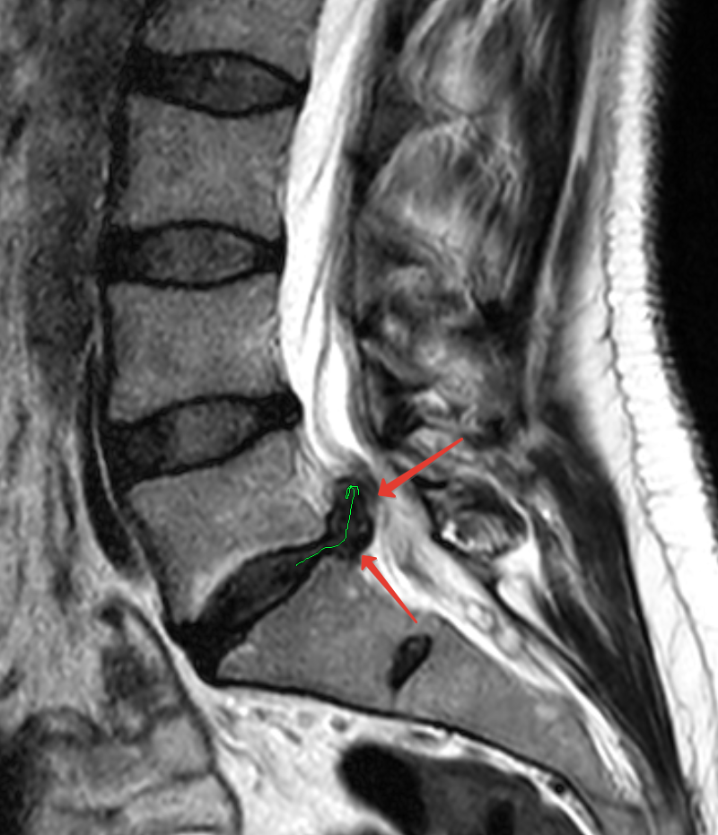 Изображение статьи Грыжа межпозвонкового диска в Тюмени и Тюменской области: первые симптомы и признаки, которые нельзя игнорировать